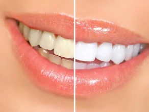 Sorriso antes e depois do clareamento dental