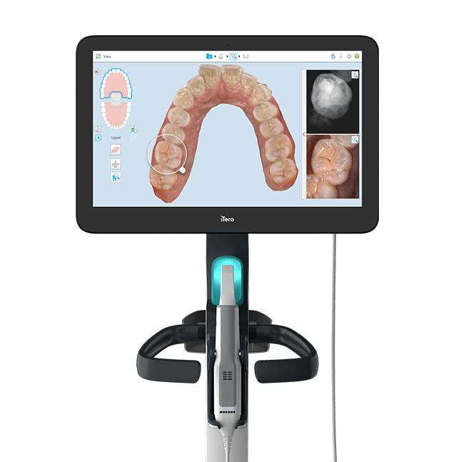 foto: Scanner Intraoral